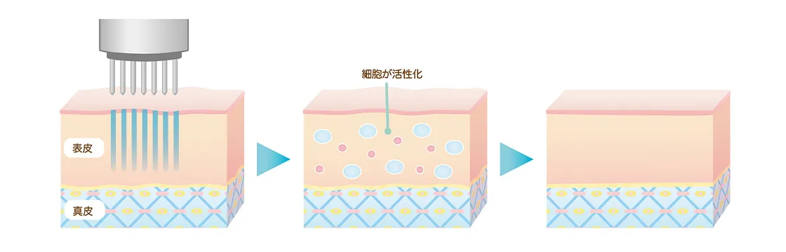 ダーマペンの治療プロセス