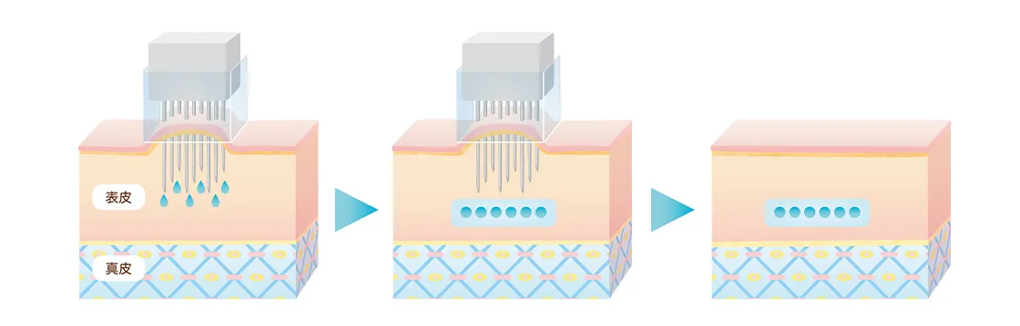 水光注射の仕組み